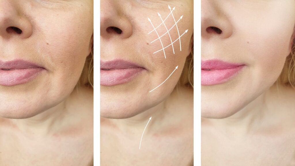 Wrinkle and Fold Correction