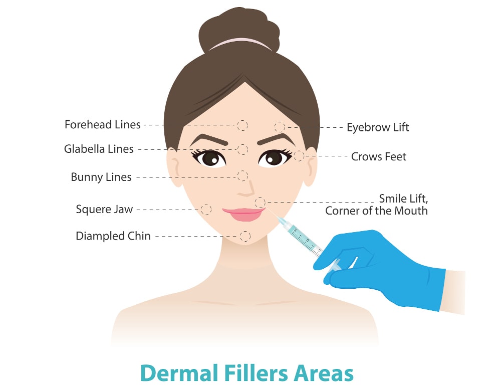 Dermal Filler Longevity and Recovery Times Table Dermal filler longevity and recovery times comparison chart
