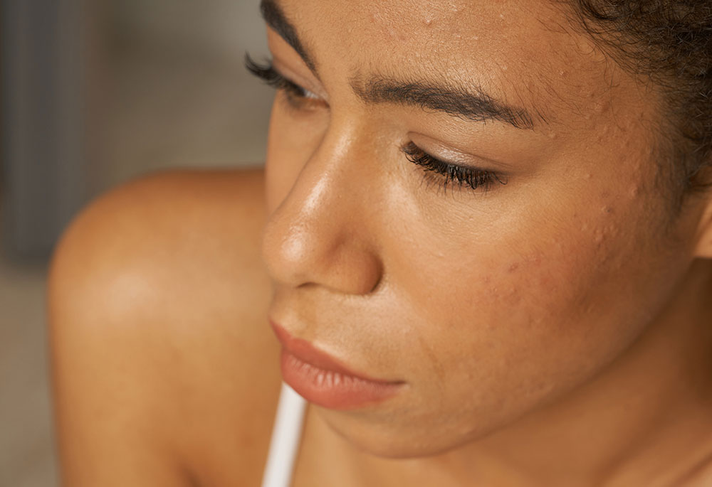 Acne Treatment