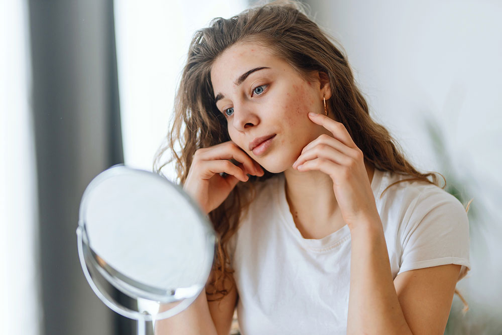 Acne on the Face.jpg