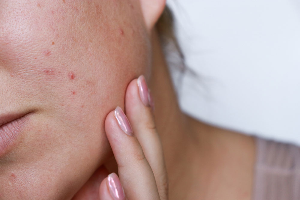 What Causes Acne on the Face?