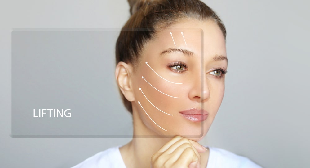 Non-surgical face lift using thread lift technique for lifting sagging skin