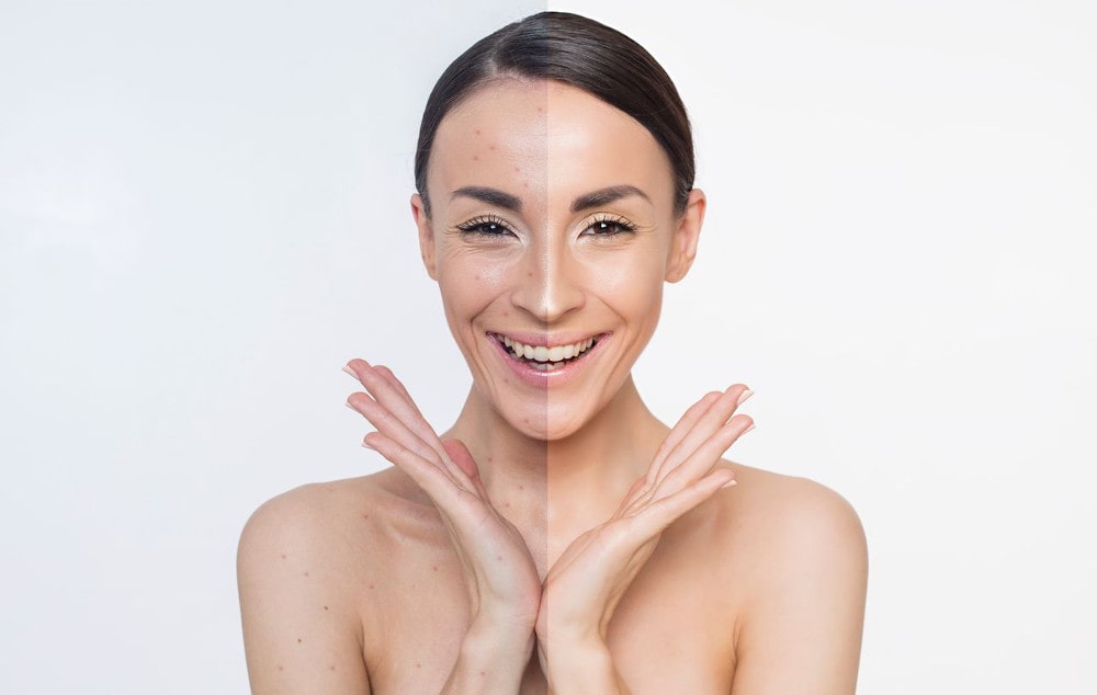 Before and after comparison of acne treatment results on a young woman’s face, showing clear skin improvement after aesthetic procedures.