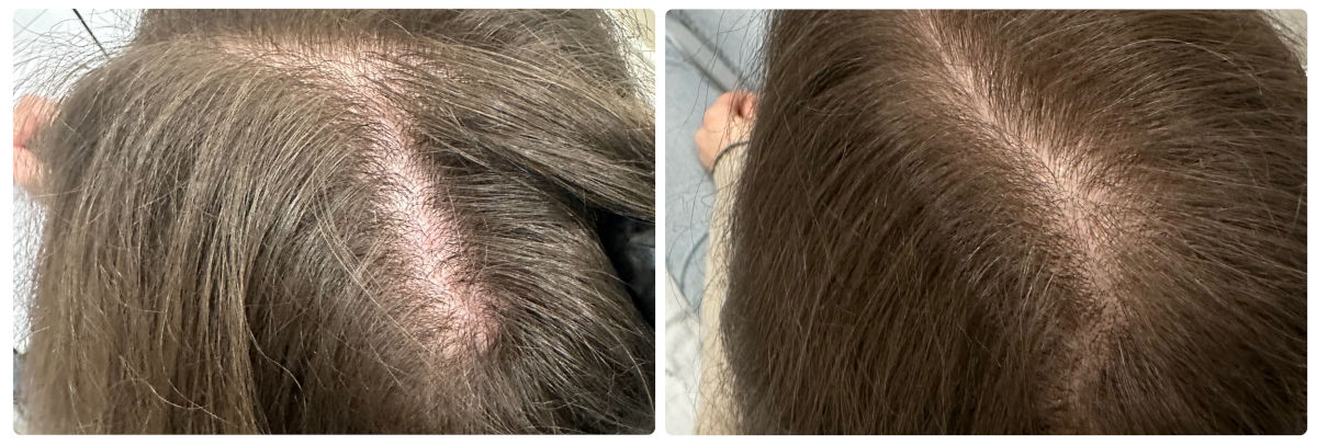 PRF before/after