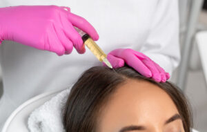 PRP for Hair Loss: When Will You See Results and How Long Do They Last?
