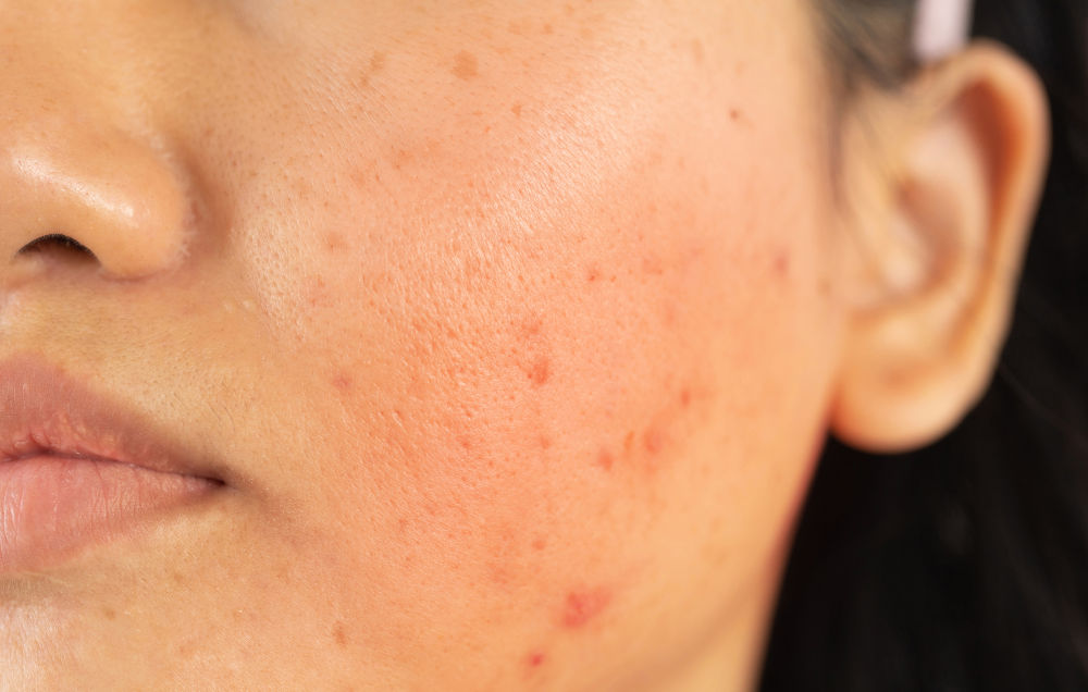 Best Acne Scar Treatments in Toronto