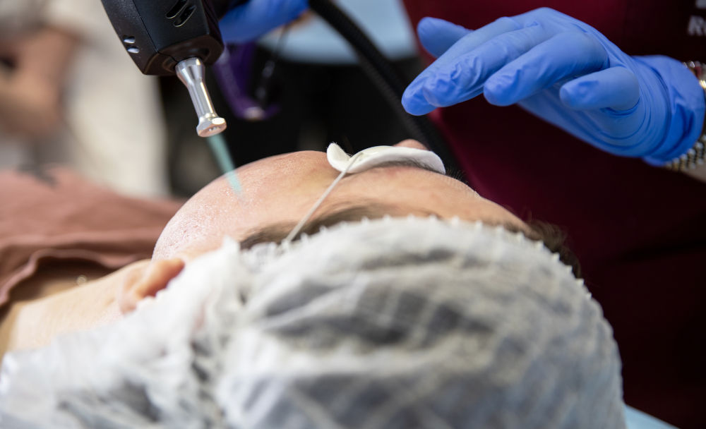 Laser Treatments for Acne Scars