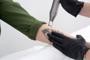 How Many Laser Tattoo Removal Sessions Will You Need?