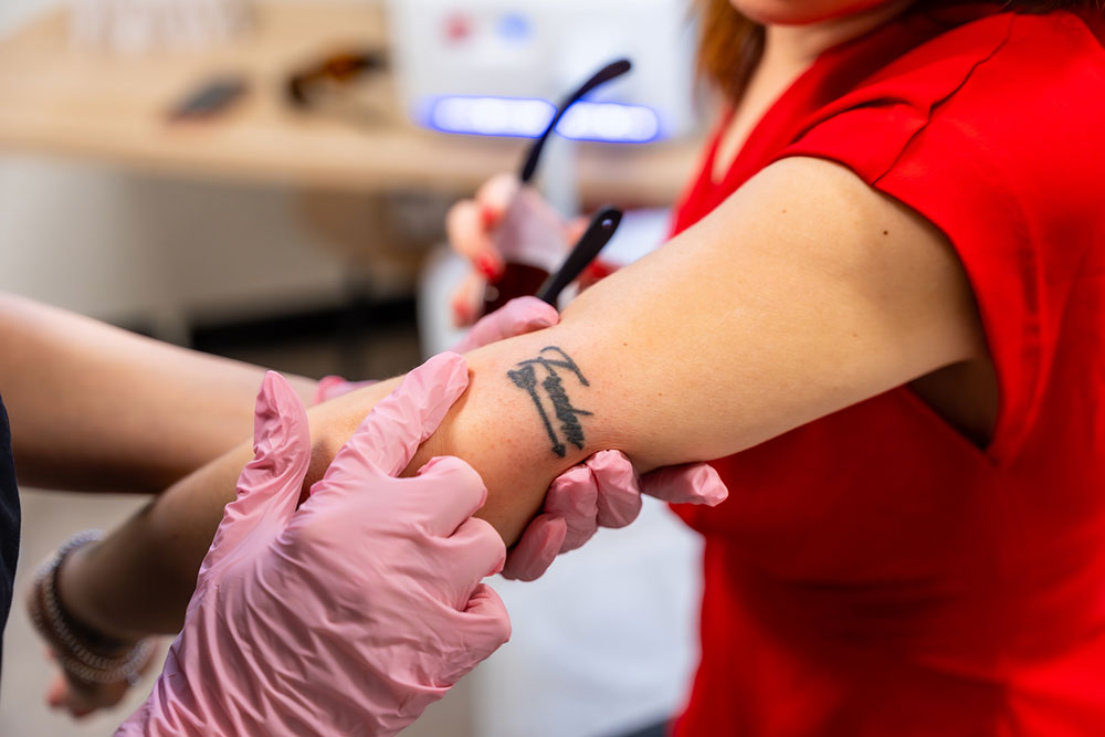 Laser Tattoo Removal Sessions