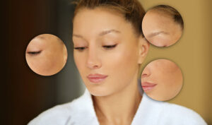 Melasma, Sun Spots, or Post-Acne Pigmentation: How to Choose the Right Treatment