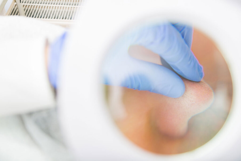 Professional Treatments for Large Pores