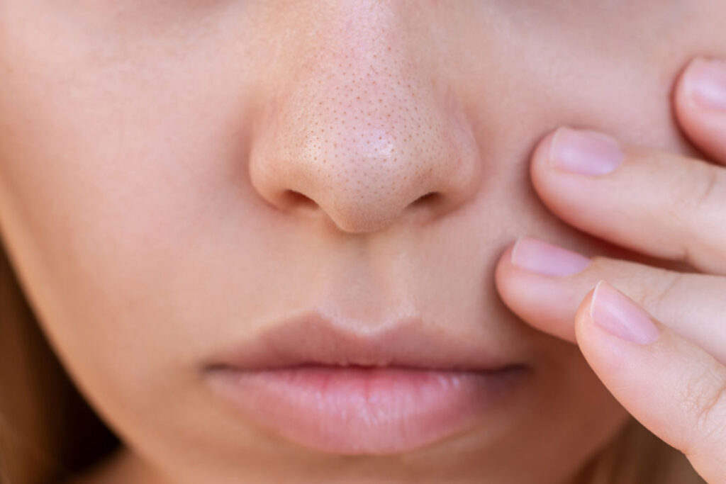 Treatments for Large Pores