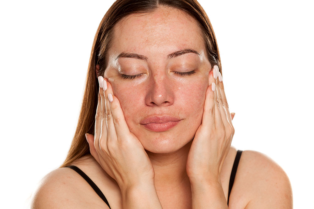 What Is Melasma?