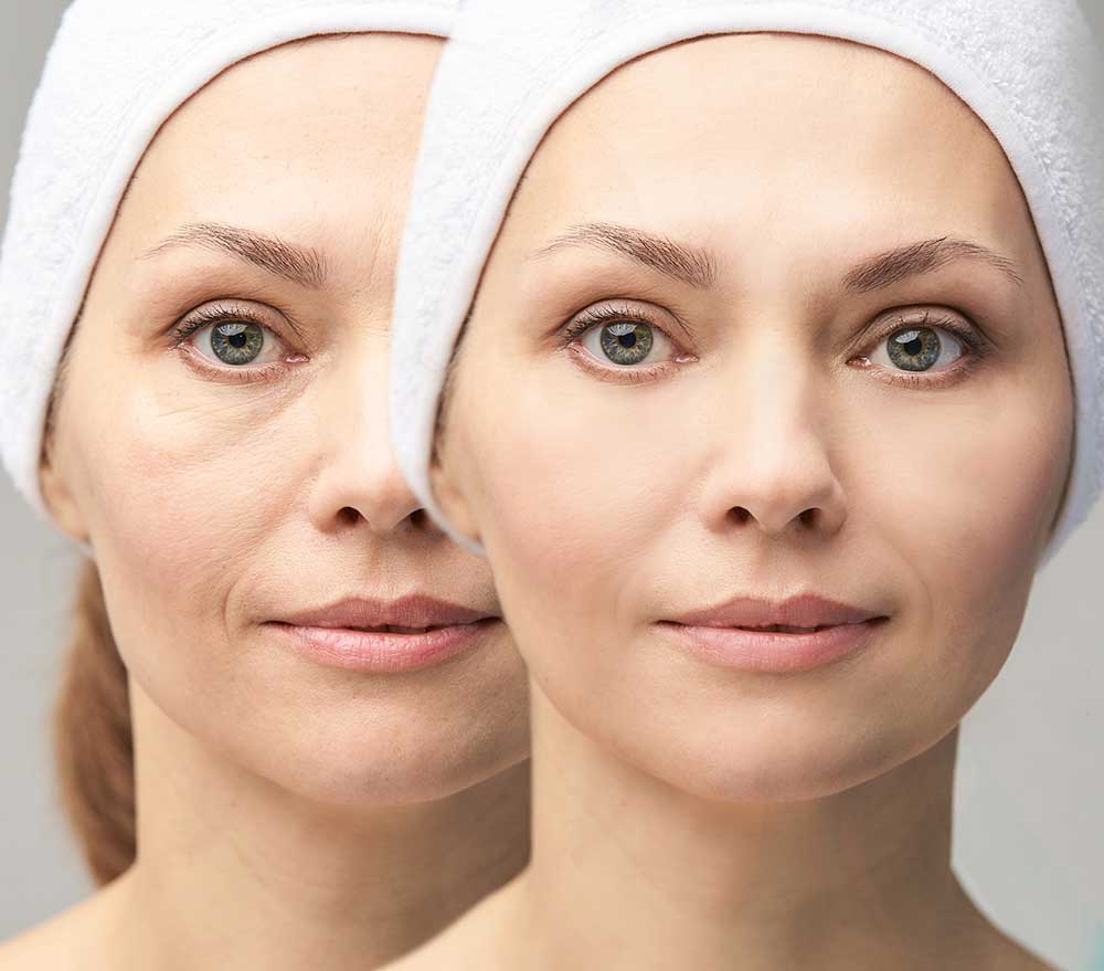 Benefits of Dermal Fillers