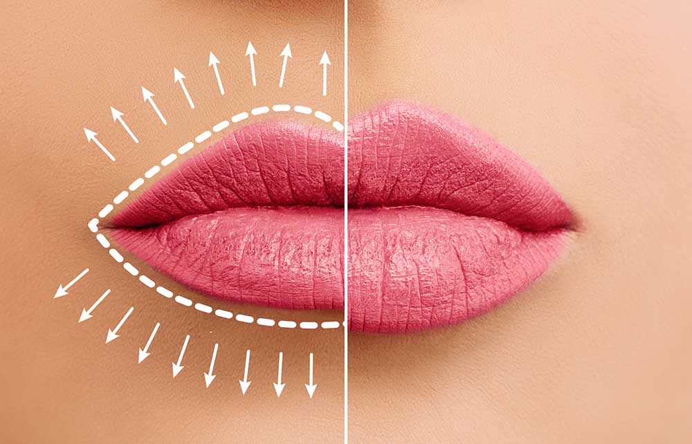How Do Lip Fillers Work?