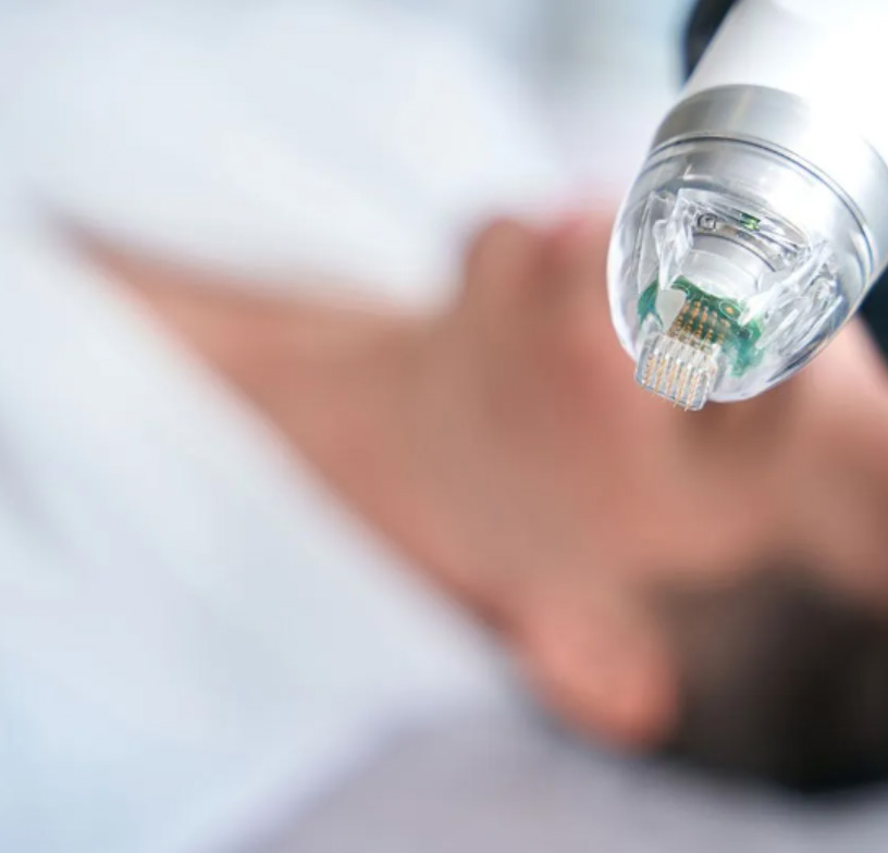 What Is Microneedling