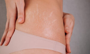 Stretch Mark Treatment