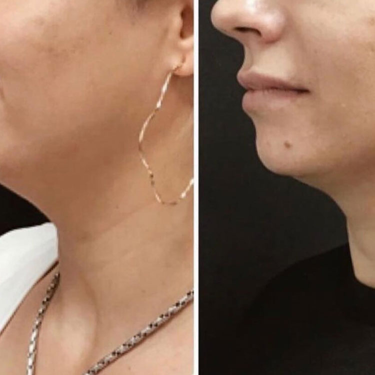 Double Chin Reduction Before After