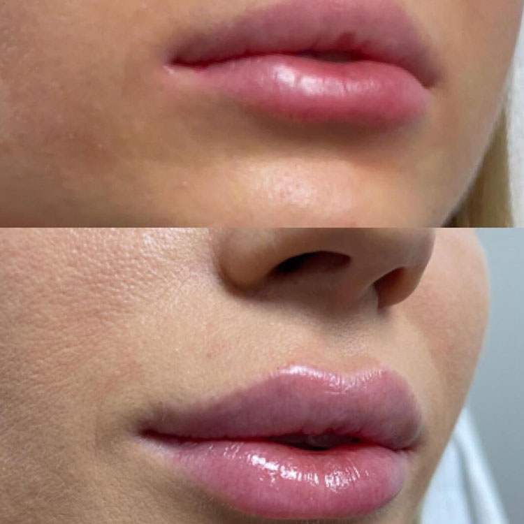 Lip Filler Before After