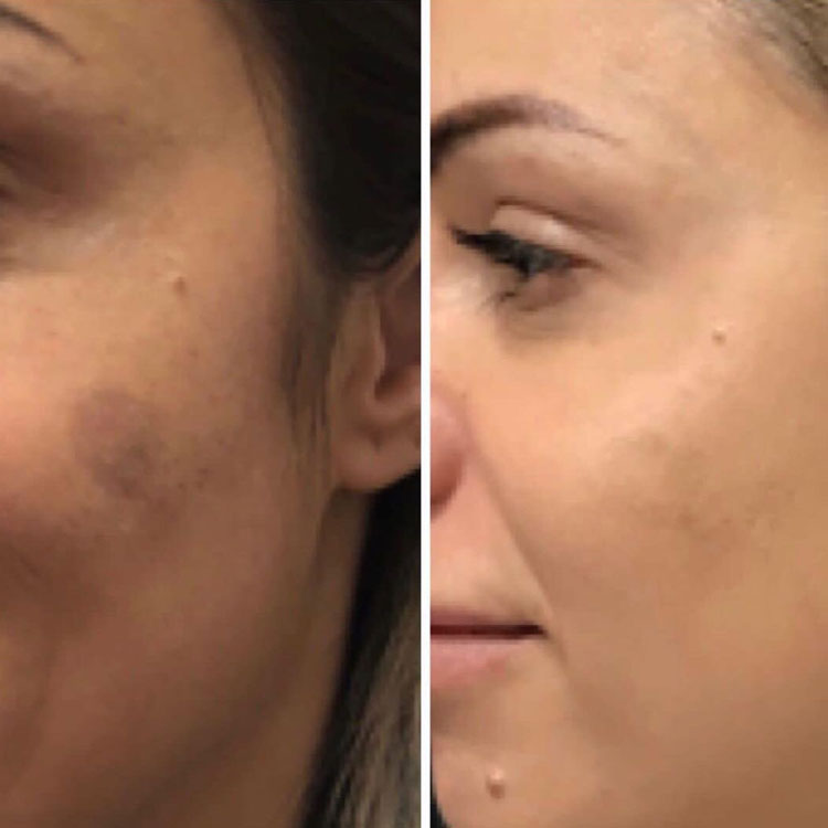 Melasma Treatment Before After